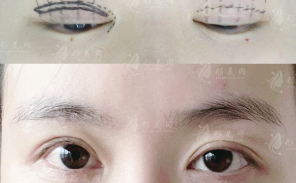上睑下垂矫正和双眼皮能一起做吗?医生建议分开做