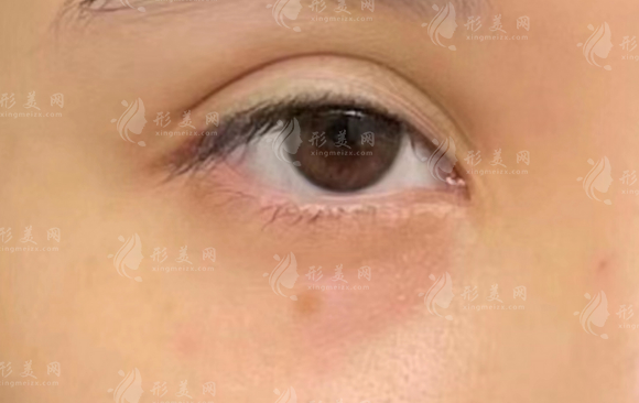 双眼皮做坏了怎么修复?术前必知这3件事