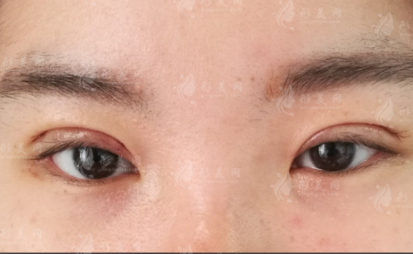 武汉双眼皮修复医生哪家好?王海平顿兆谭琳等实力测评