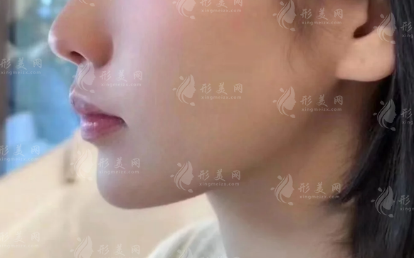 北京漾格李在郁下颌缘提升效果怎么样?深层固定+线条衔接实测