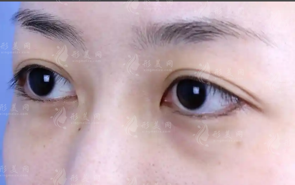 罗文婷双眼皮眼修复多少钱?技术风格适合人群全解析 罗文婷双眼皮眼修复多少钱?技术风格适合人群全解析