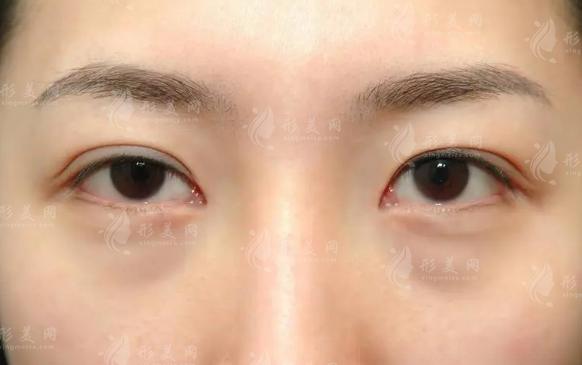 沈阳内吸去眼袋医生怎么选?房红超张莹莹杜继凤测评