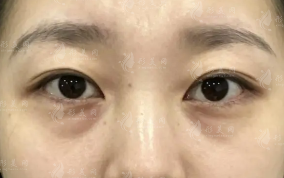 汪栋梁泪沟修复口碑如何?眶隔脂肪释放面诊全攻略