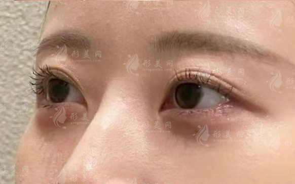 西安李超双眼皮口碑如何?自然审美眼修复面诊攻略