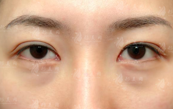 西安眼部整形医院怎么选?亚美艺星医生面诊攻略