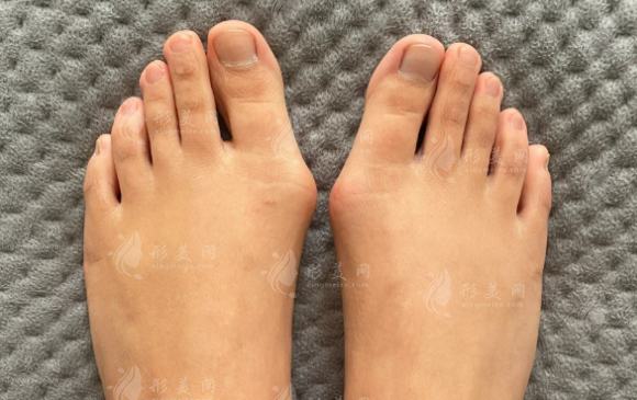 北京陈圣英大脚骨矫正怎么约?圣嘉新费用面诊攻略