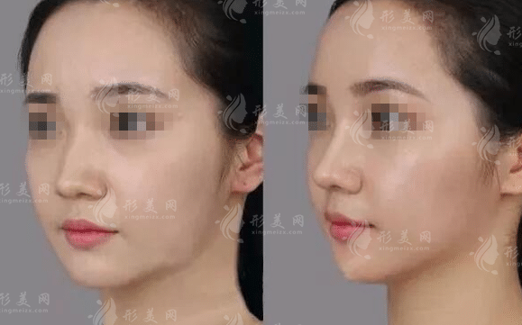 鼻综合不满意想修复?先看是审美问题还是技术问题 鼻综合不满意想修复?先看是审美问题还是技术问题