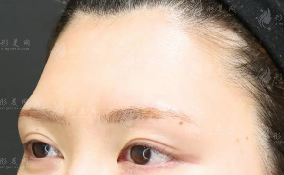 哈尔滨杨宇梓脂肪填额头技术好吗?寿星额避坑+价格全攻略