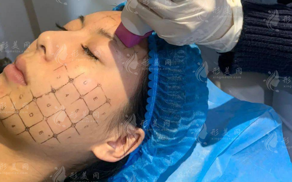 热玛吉和超声炮怎么选?作用层次+适合人群一次讲清 热玛吉和超声炮怎么选?作用层次+适合人群一次讲清