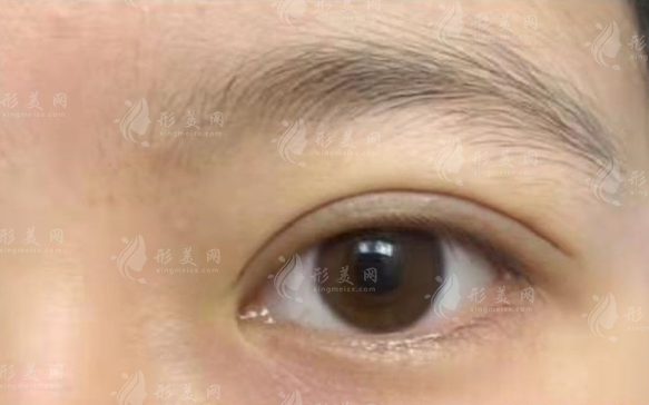 魏志香双眼皮修复怎么样?北京丽星翼美技术+价格全解析 魏志香双眼皮修复怎么样?北京丽星翼美技术+价格全解析