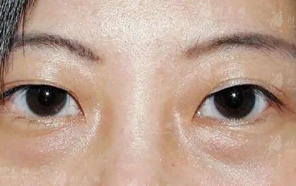 徐晓斐和朱迪双眼皮怎么选?初眼修复面诊全攻略 徐晓斐和朱迪双眼皮怎么选?初眼修复面诊全攻略