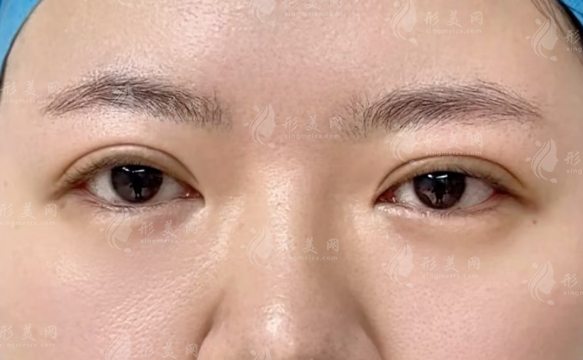 杨权明修复双眼皮适合哪种眼?眼型基础与脸型匹配全解析 杨权明修复双眼皮适合哪种眼?眼型基础与脸型匹配全解析