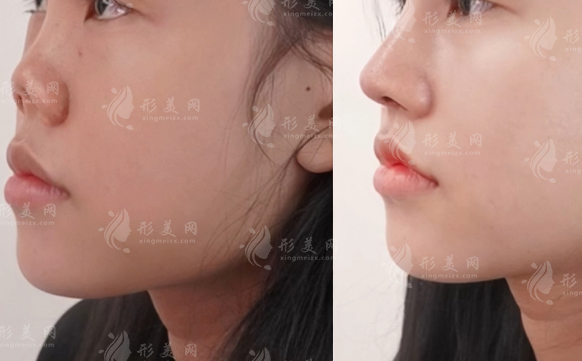 深圳千丽医疗美容价格表!李信锋鼻整形郑梦雄吸脂费用公开