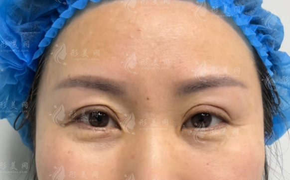 北京客莱美舍张冰洁眼修复价格一览：双眼皮/眼角修复多少钱?