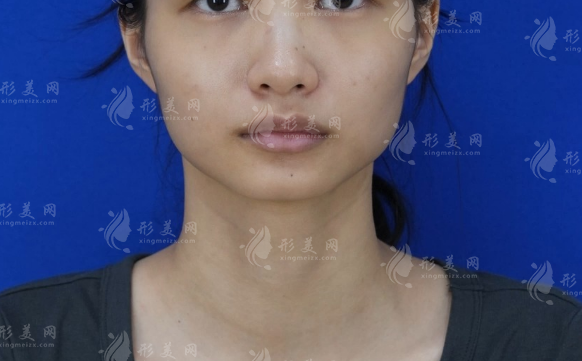 成都磨骨医生怎么选?赵延峰张立天刘剑锋技术重点对比