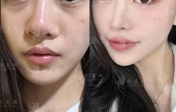 刘超医生缩鼻翼鼻头怎么样?妈生感面诊避坑指南