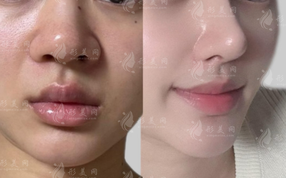 深圳千丽李信锋做鼻子怎么样?自然不增生口碑解析 深圳千丽李信锋做鼻子怎么样?自然不增生口碑解析