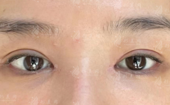沈阳孙常青医疗美容诊所怎么样?双眼皮修复悬眉祛眼袋解析
