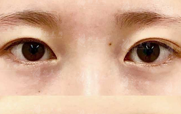 双眼皮做坏了多久能修复?别急着动刀，窗口期讲清楚