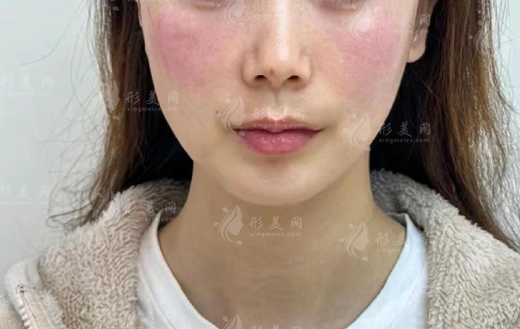 谭琳琳轻薄提升一万多够吗?玻尿酸3k起到乔雅登1w+预算分析 谭琳琳轻薄提升一万多够吗?玻尿酸3k起到乔雅登1w+预算分析