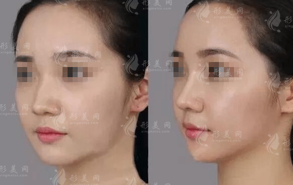 深圳挛缩鼻修复找李信锋院长?千丽整形价格7万起值不值 深圳挛缩鼻修复找李信锋院长?千丽整形价格7万起值不值
