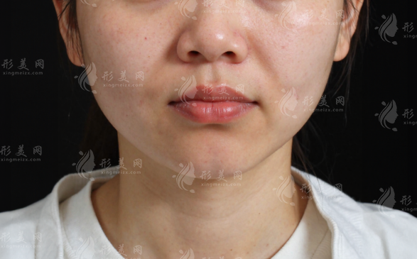 杨胤恒减容提升好吗?馒清提升反馈别只看脸小 杨胤恒减容提升好吗?馒清提升反馈别只看脸小