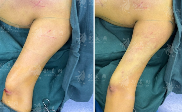 长沙谢超医生吸脂价格贵吗?腰腹8800起折角腰15000起 长沙谢超医生吸脂价格贵吗?腰腹8800起折角腰15000起
