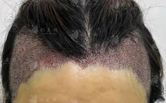 不剃发植发为什么被医生劝退?真不只是费用高 不剃发植发为什么被医生劝退?真不只是费用高