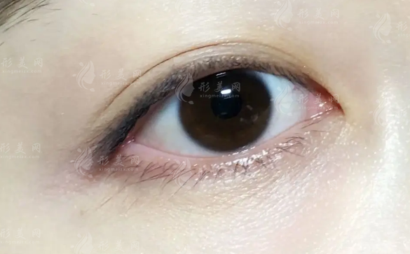 东莞割双眼皮和修复去哪看?10家正规医美名单费用参考 东莞割双眼皮和修复去哪看?10家正规医美名单费用参考