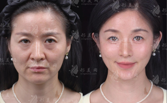 广州黄文亭眼周提升怎么样?眼尾松眼袋价格8800起