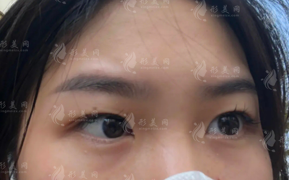 李天石眼整形收费贵吗?双眼皮6000起去眼袋5000起