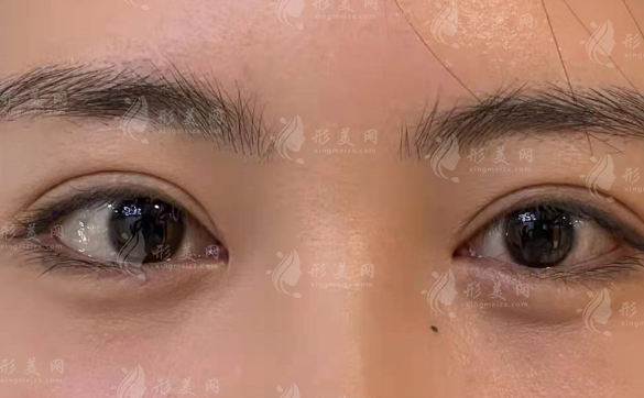 田芳斌和罗荣兴双眼皮怎么选?自然款与精致风对比