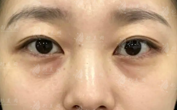 眼袋泪沟黑眼圈能一起改善吗?眶隔释放术先看类型