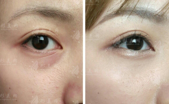 眼综合项目越多越精致吗?开眼角提肌双眼皮要分开看