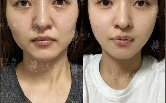 医美抗衰多久做一次合适?别把脸排成项目日历