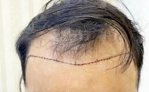 FUE和微针植发哪个好?取发种发方向与发际线设计对比