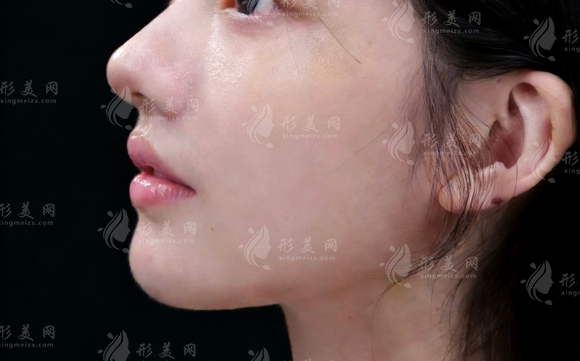兰州隆鼻医院排名：维多利亚亚韩时光激光优势与价格