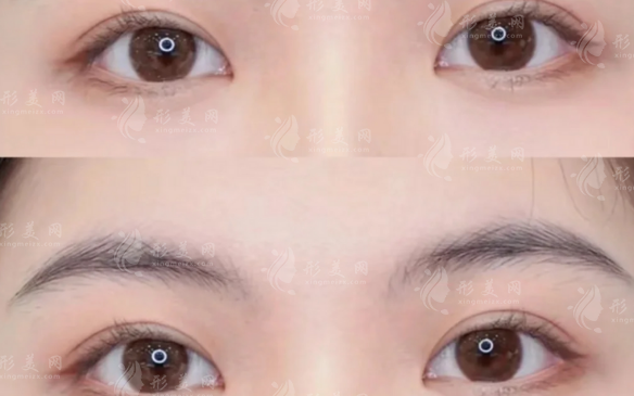 埋线双眼皮和全切双眼皮怎么选?眼型维持与修复对比