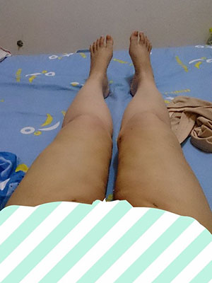 【大腿环吸+肉毒素瘦小腿】实现长腿美女不是梦 - 珍美网