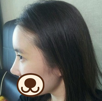 鼻部整形 变侧颜气质美女 - 珍美网