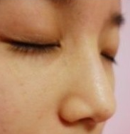 隆鼻整形 做勇敢美丽的自己 - 珍美网