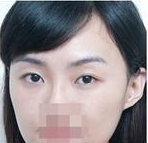 注射玻尿酸  熊猫眼也可以消的干净 - 珍美网