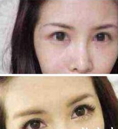 注射丰卧蚕 怎么样都很美 - 珍美网