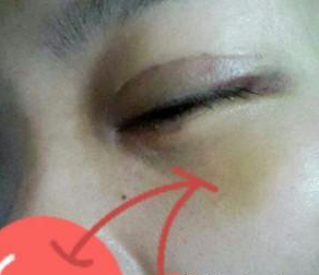 鱼尾纹除皱 美丽起来不是大问题 - 珍美网