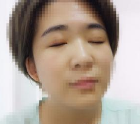 双眼皮手术  面部整体看起来美腻好多啊
