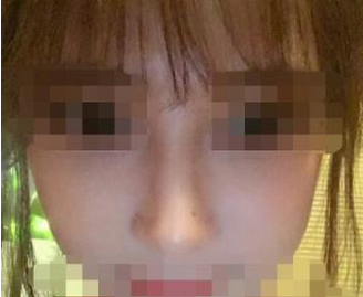玻尿酸填充鼻梁  精致立体的五官让我美的不要不要的
