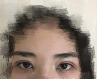 双眼皮手术  眼睛变亮变大更让人喜爱