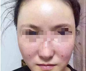 自体脂肪面部填充 焕然一新  - 珍美网