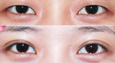 埋线双眼皮恢复期是多久?