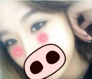 微创双眼皮手术  让我眼睛更加美丽动人 - 珍美网
